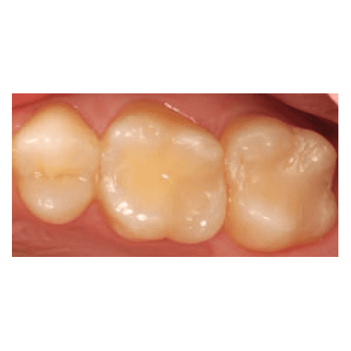 Tetric EvoCeram Bulk Fill (2 yr)