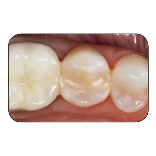 Tetric EvoCeram® (10 yr)