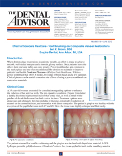 Effect of Sonicare FlexCare+ Toothbrushing on Composite Veneer Restorations
